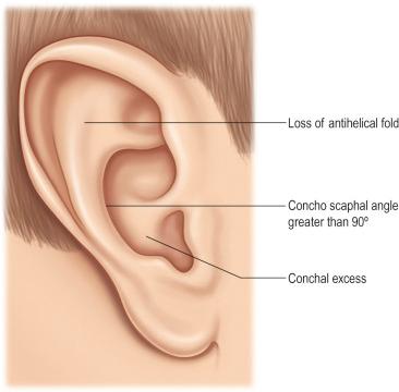 Figure 5.2, Main components of the prominent ear.