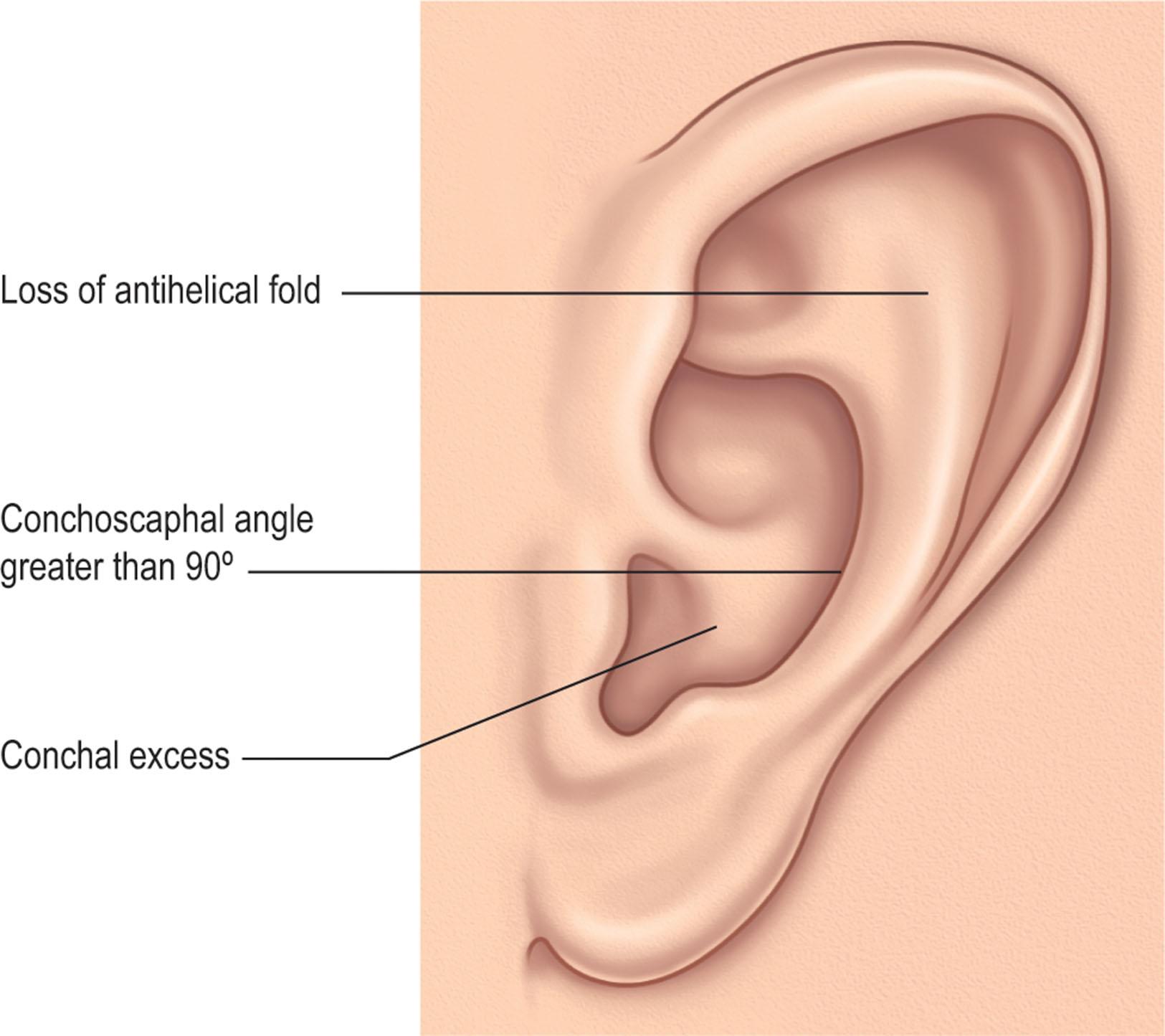 Figure 23.2, Main components of the prominent ear.