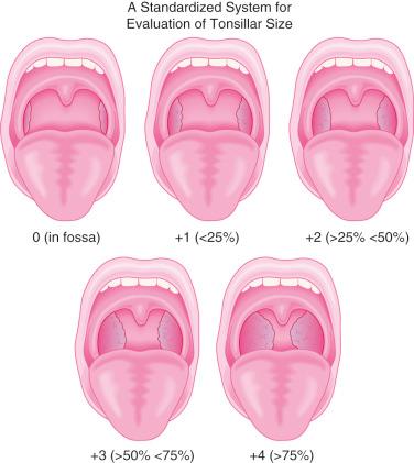 FIGURE 33.4, Classifying tonsil size may be helpful in evaluating the degree of airway obstruction. Children classified as +3 or greater (i.e., having more than 50% of the pharyngeal area occupied by hypertrophied tonsils) are at an increased risk of developing airway obstruction during anesthetic induction.