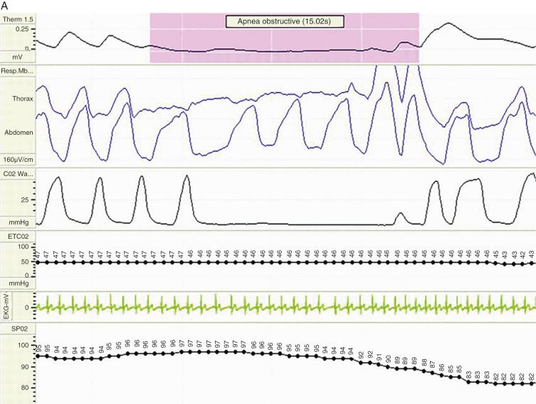 FIGURE 33.5, Typical polysomnographic recordings demonstrating obstructive apnea (A), hypopnea (B), and central apnea (C) .