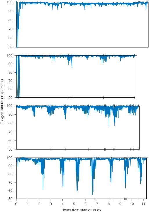 FIGURE 33.7, Representative figures for McGill oximetry scores 1 to 4 ( top to bottom ) . McGill oximetry scores 2 to 4 are abnormal in that they all show at least three clusters of desaturation. The severity of the Sp o 2 nadir determines the score such that McGill oximetry scores 2, 3, and 4 correspond to Sp o 2 nadirs of less than 90%, less than 85%, and less than 80%, respectively.