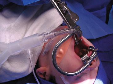 E-FIGURE 33.1, Laryngeal mask airway made for ear, nose, and throat surgery.