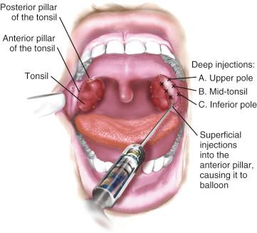 E-FIGURE 33.2, Tonsillar infiltration.