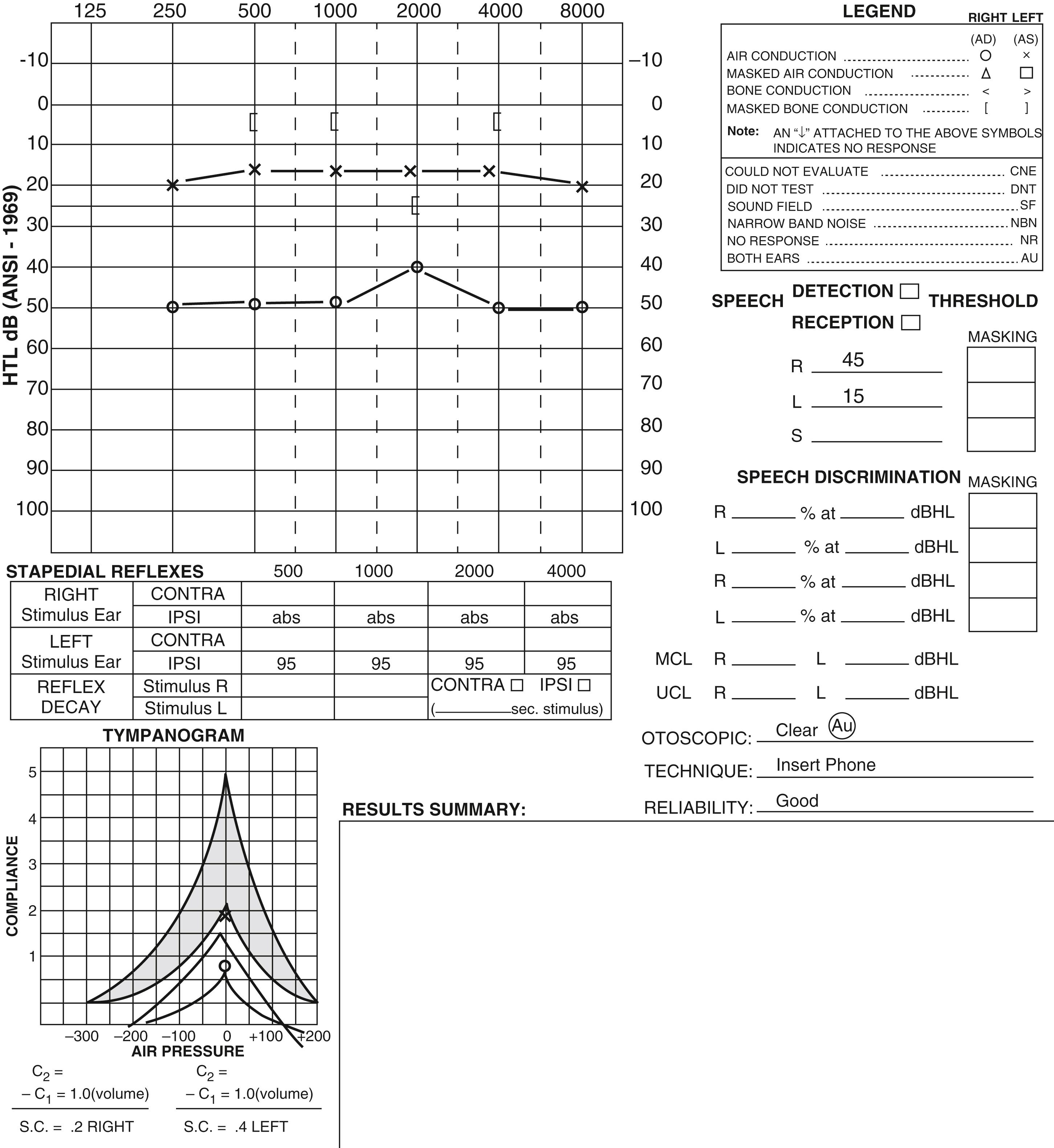 Fig. 133.1, Audiogram showing right conductive hearing loss and a sensorineural dip at 2000 Hz indicative of Carhart notch.