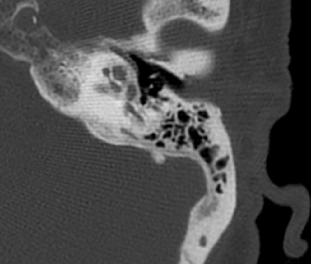 Fig. 133.2, Extensive cochlear demineralization may result in the double ring or halo sign.