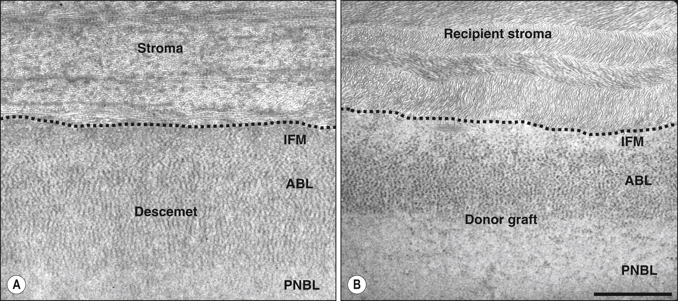 Fig. 137.1, Transmission electron micrographs showing the Descemet–stroma interface (dotted line) in ( A ) normal cornea and ( B ) the graft–stroma interface (dotted line) after Descemet membrane endothelial keratoplasty. ABL , Anterior banded layer; IFM , interfacial matrix; PNBL , posterior nonbanded layer; magnification bar = 3 μm.