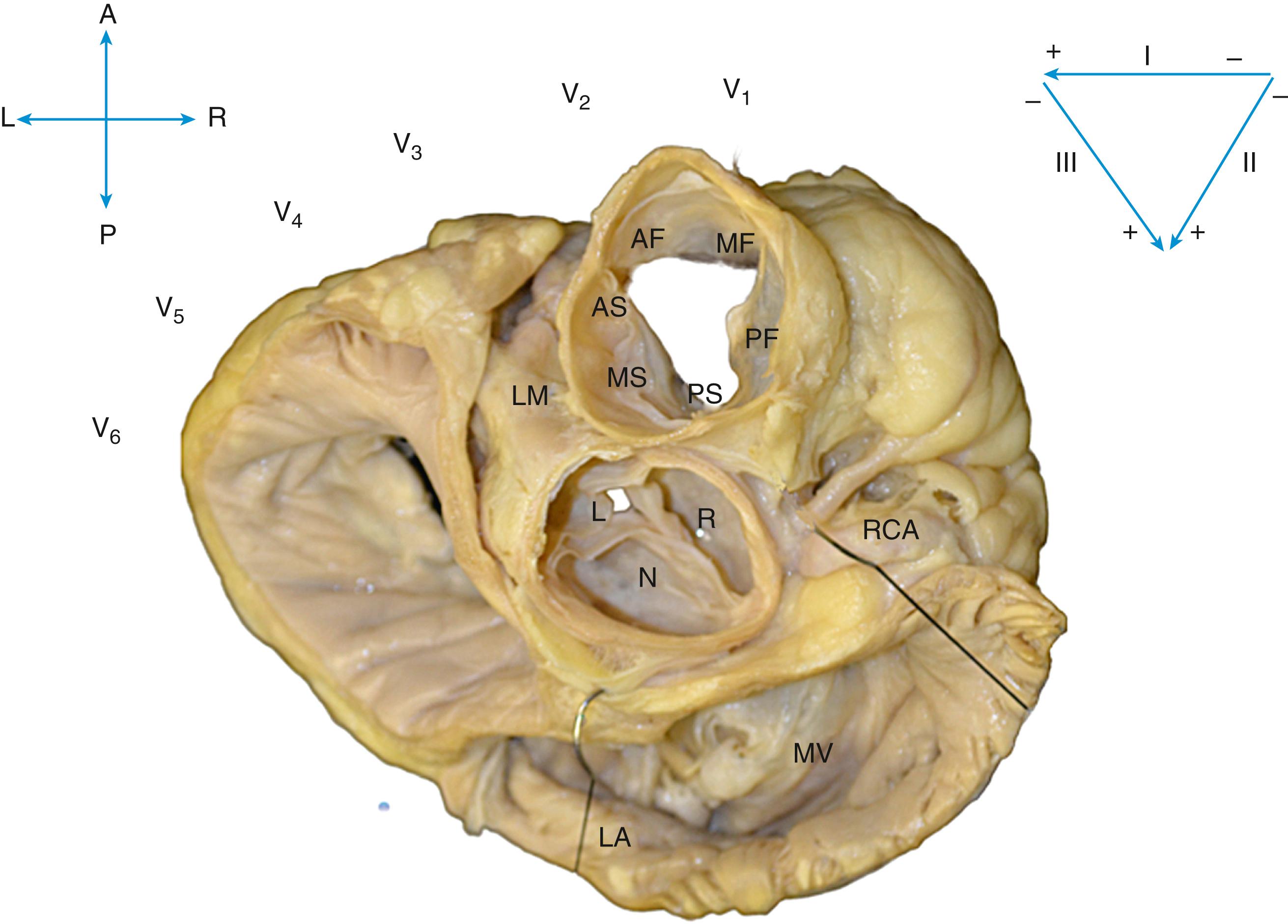 Fig. 81.1, Superior view of the human heart with the atria, pulmonary artery, and aorta cut away.