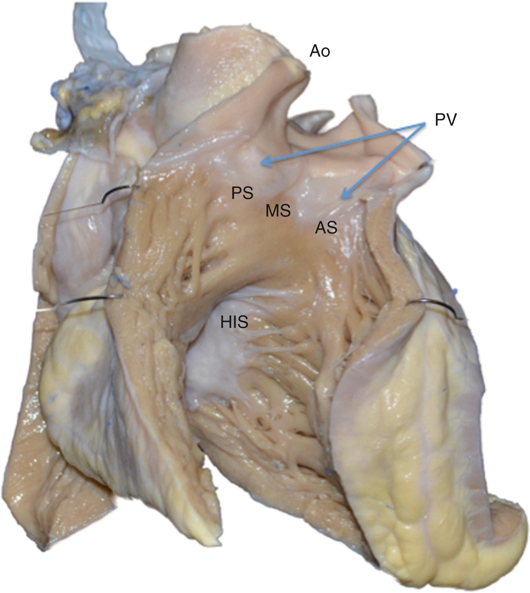 Fig. 81.2, Anterior view of the human heart, with the free wall of the right ventricle cut open.