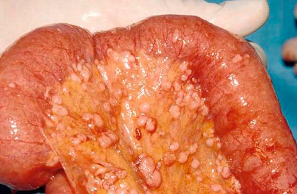 FIGURE 39-1, Numerous small metastatic tumor nodules scattered around the mesentery of the small bowel.