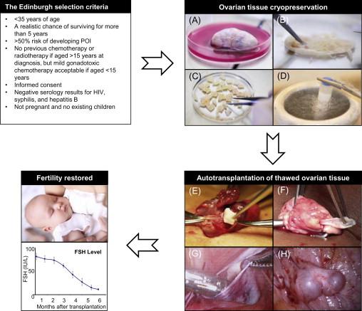 Figure 7.1, Cryopreservation of ovarian tissue for fertility preservation.