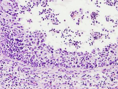 Figure 35.15, Lymphocytic and plasmacytic infiltrate of a developing follicle in autoimmune oophoritis.