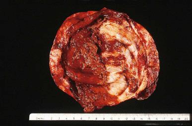 Figure 35.16, Inner surface of cyst in a case of ovarian endometriosis. The color is typically brown.