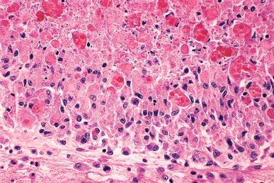 Figure 35.18, Necrotic nodule surrounded by histiocytes in pelvic endometriosis.