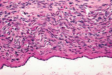 Figure 35.23, Single layer of bland-looking epithelial cells lining one of the cystic structures of a serous cystadenoma.