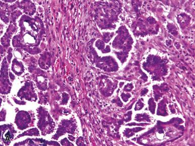 Figure 35.24, Low-Grade Serous Carcinoma.