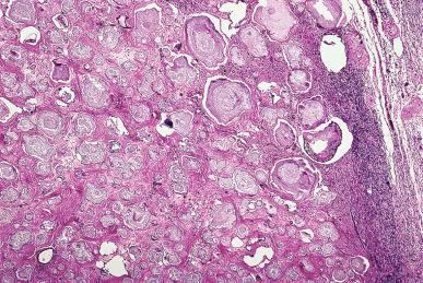 Figure 35.25, Low-grade serous carcinoma with innumerable psammoma bodies, so-called serous psammocarcinoma.