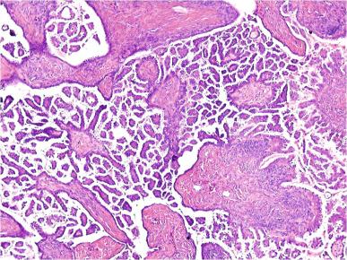 Figure 35.28, Ovarian serous borderline tumor with a micropapillary pattern of growth.