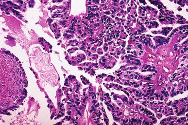 Figure 35.29, High-grade serous carcinoma with papillary architecture.