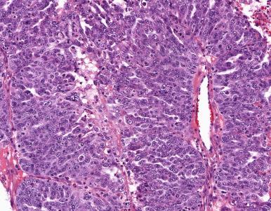 Figure 35.30, High-grade serous carcinoma with slit-like spaces.