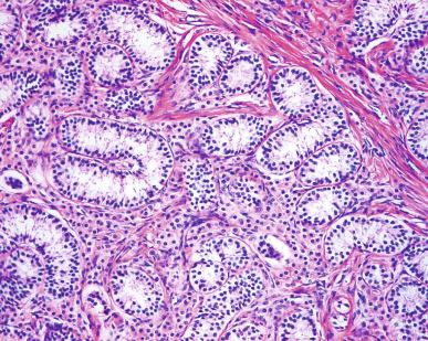 Figure 35.3, Immature testicular tubules in testicular feminization syndrome.