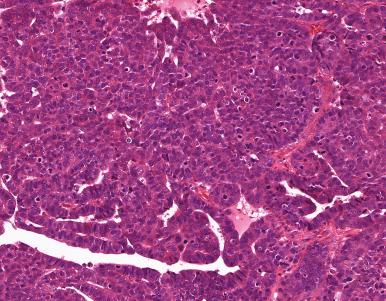 Figure 35.31, High-Grade Serous Carcinoma With Gland Formation.