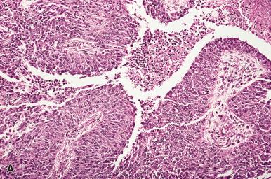 Figure 35.32, A and B, High-grade serous carcinoma with solid and transitional-like architecture.