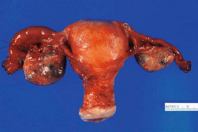 Figure 35.5, Outer appearance of bilateral ovarian follicular cysts.