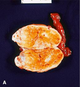 Figure 35.9, Ovarian Stromal Hyperplasia.