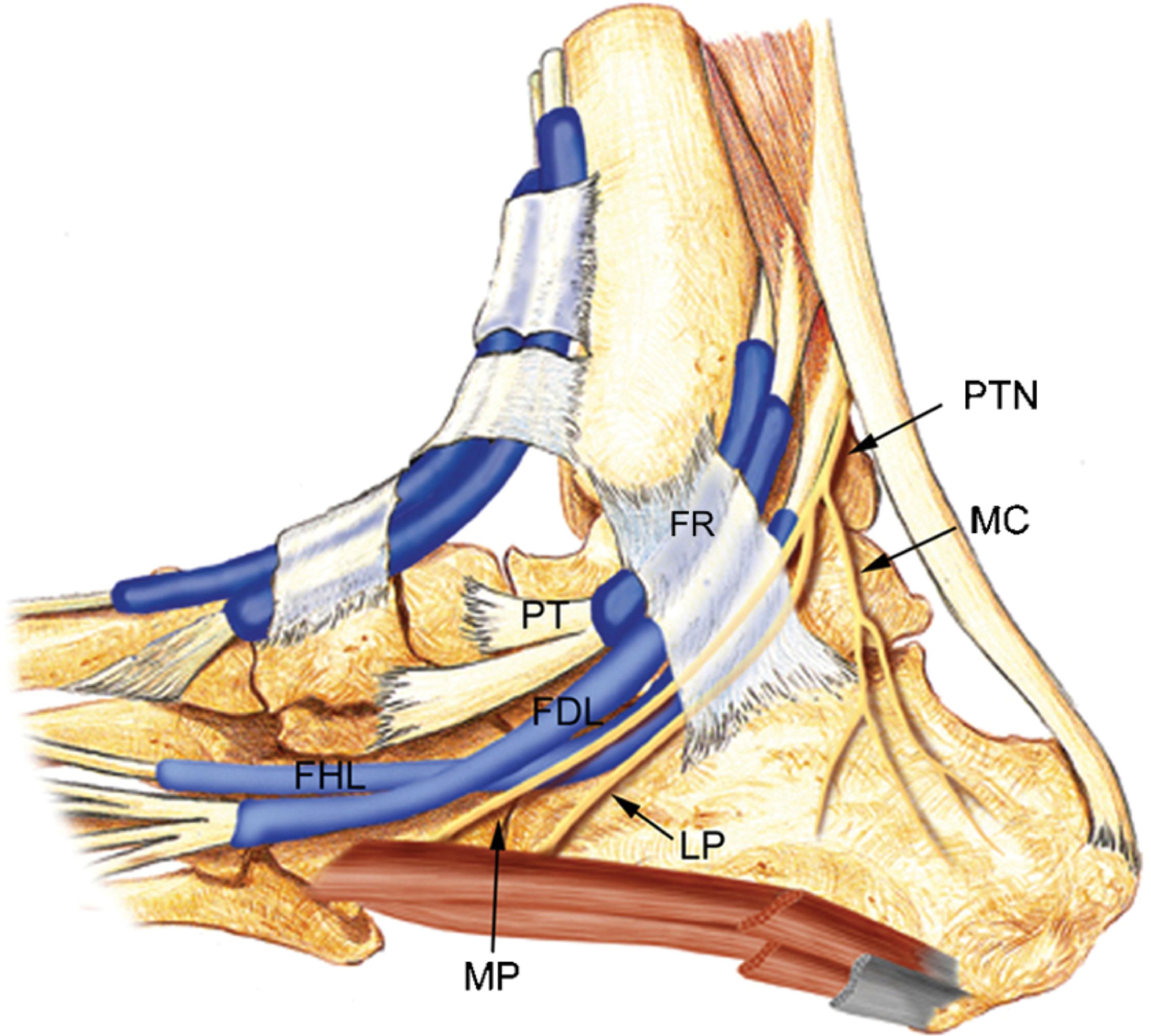 Figure 39.2, Target and nerve diagram for peripheral tibial nerve stimulation. Posterior division of sciatic nerve indicated in green, anterior in orange. Blue dotted line traces stimulation signal from distal stimulation site at peripheral tibial nerve activating proximal sacral nerves.