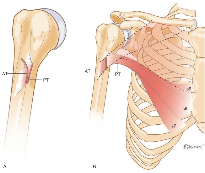 Fig. 20.2, A, The anterior part of the tendon inserts more anterior and distal relative to the posterior tendon. B, The posterior tendon is formed by the most inferior two or three segments (s5–s7) of the sternocostal head. AT, Anterior Portion of the Tendon; PT, Posterior Portion of the Tendon.