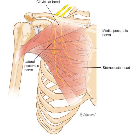 Fig. 20.3, Illustration demonstrating the nerve supply to the pectoralis major muscle.