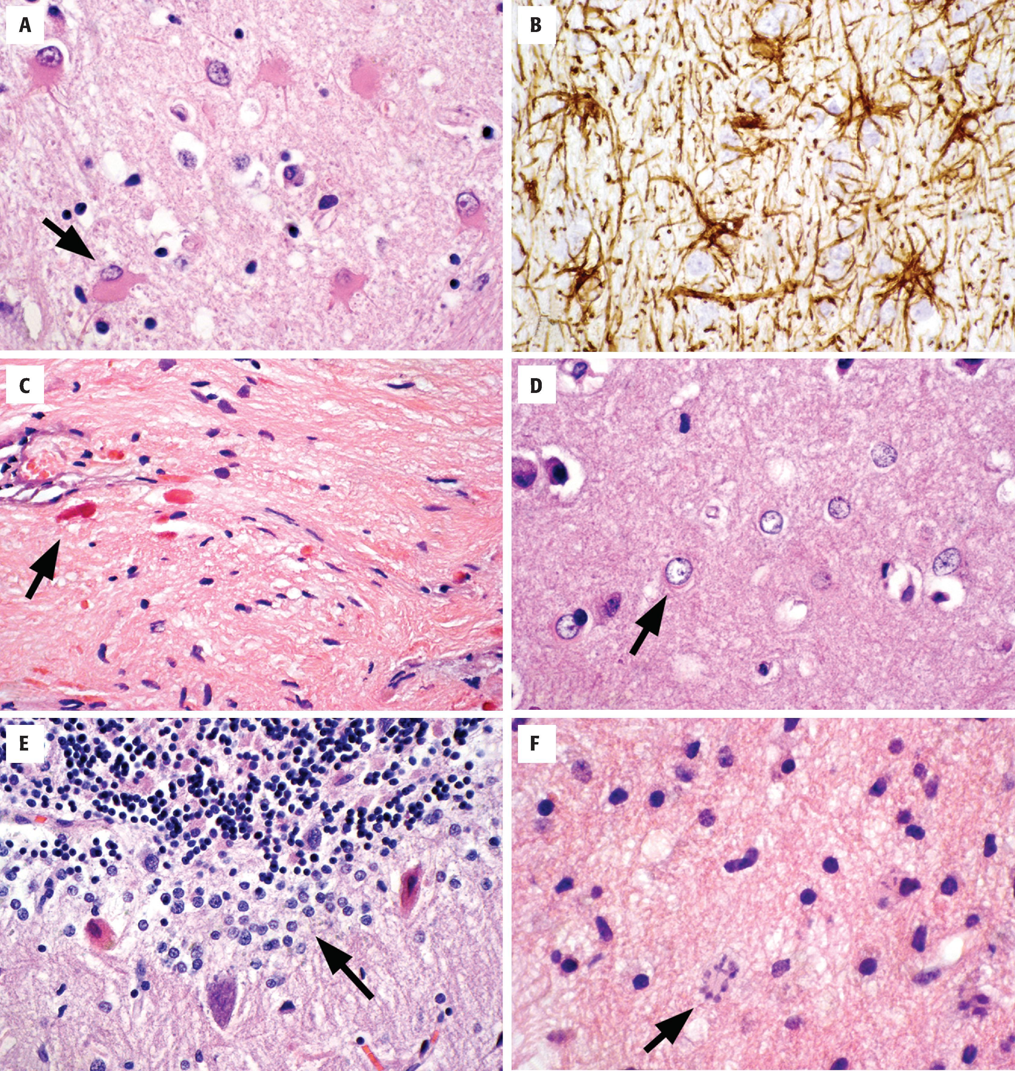 FIGure 1.11, Reactive glia. A , Gemistocytic astrocytes ( arrow ) are one form of reactive change in which the astrocytic cytoplasm is distended and eosinophilic and its processes are readily identified. B , Immunohistochemistry for GFAP highlights reactive astrocytes and emphasizes their star-like quality. C , Piloid gliosis is a highly fibrillar form of reactive gliosis that is composed of dense, elongate astrocytic processes that are tightly packed together. Rosenthal fibers ( arrow ) can often be seen in piloid gliosis. D , Alzheimer type II astrocytes ( arrow ) have enlarged, clear nuclei and are seen in states of hyperammonemia. E , Bergmann gliosis ( arrow ) occurs at the interface of the molecular and granular layers of the cerebellum, generally in response to Purkinje cell injury. F , Creutzfeldt cells (granular mitoses; arrow ) are reactive cells with fragmented nuclear material that can be mistaken for mitotic figures.
