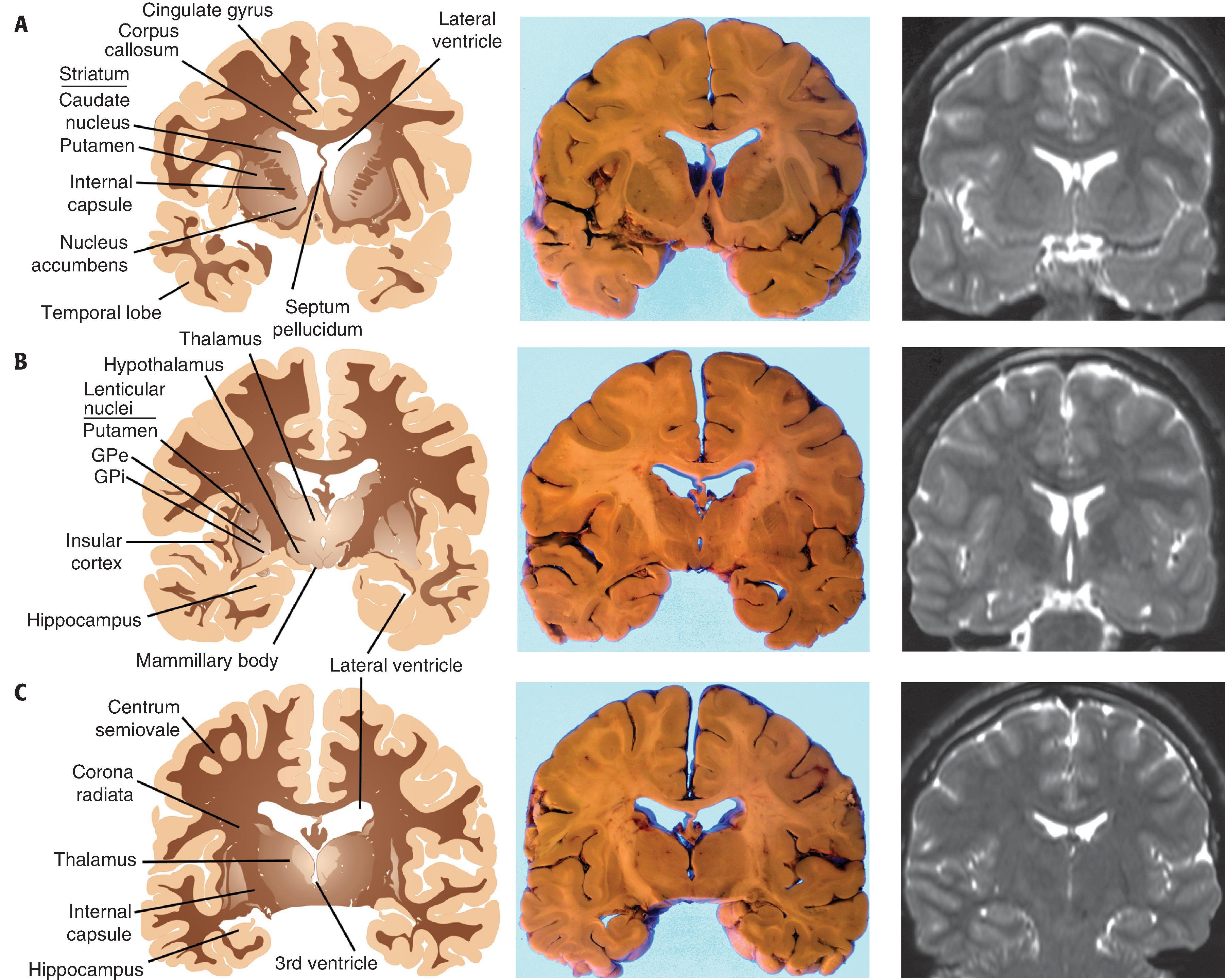 FIGure 1.4, Coronal sections of the cerebrum at the level of the striatum ( A ), mammillary bodies ( B ), and thalamus ( C ). Labeled schematic representations ( left ), fixed postmortem brain slices ( middle ), and T2-weighted MRI ( right ) are shown for each level. GPe , Globus pallidus external; GPi , globus pallidus internal.