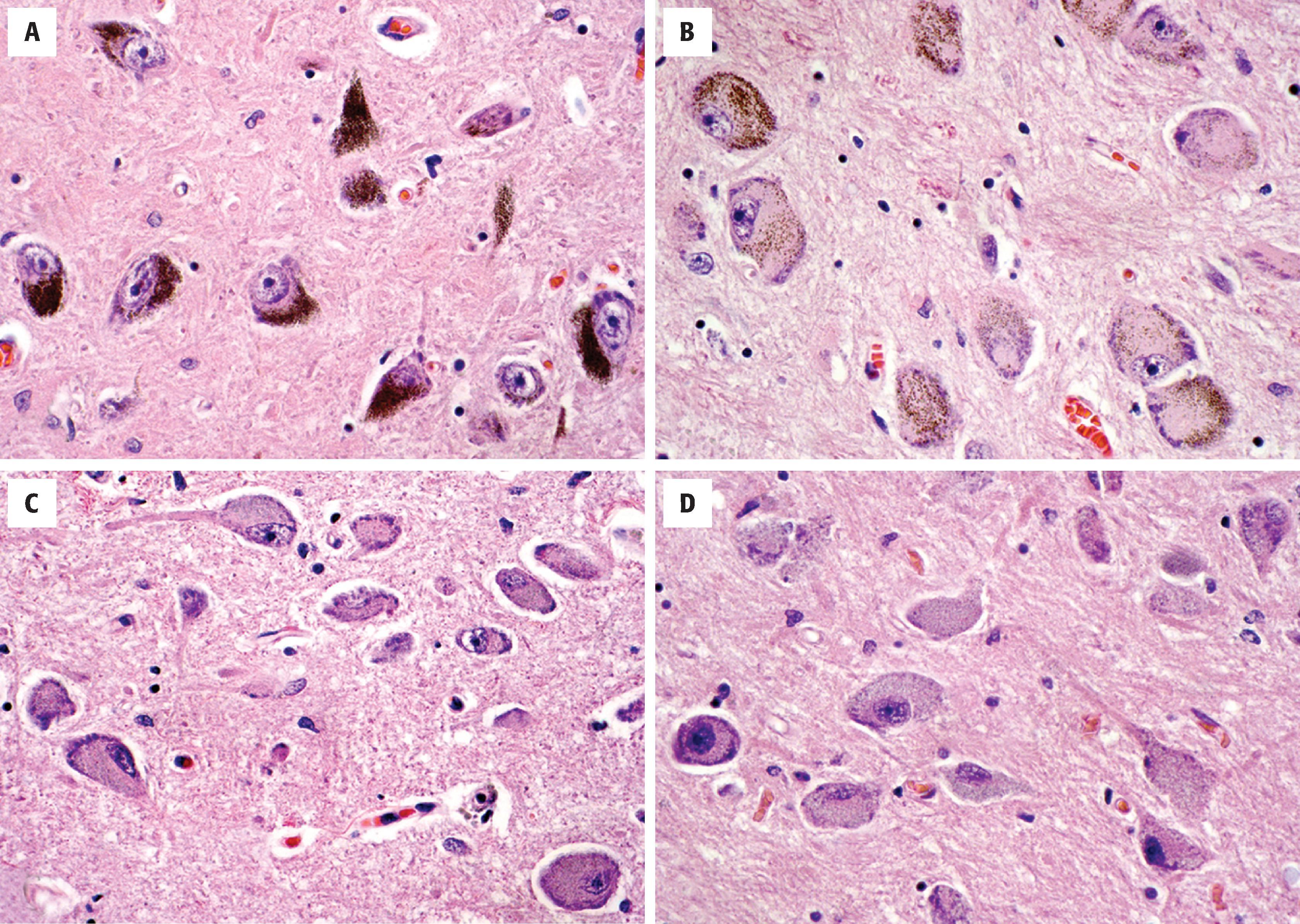 FIGure 1.9, Diffusely projecting neurons producing specific bioaminergic neurotransmitters. A , Dopaminergic neurons of the substantia nigra are deeply pigmented due to accumulation of neuromelanin. B , Neurons of the locus coeruleus are also pigmented and produce norepinephrine. C , Near the midline in the brain stem are serotonergic neurons of the raphe nuclei. D , Neurons of the nucleus basalis of Meynert produce acetylcholine.