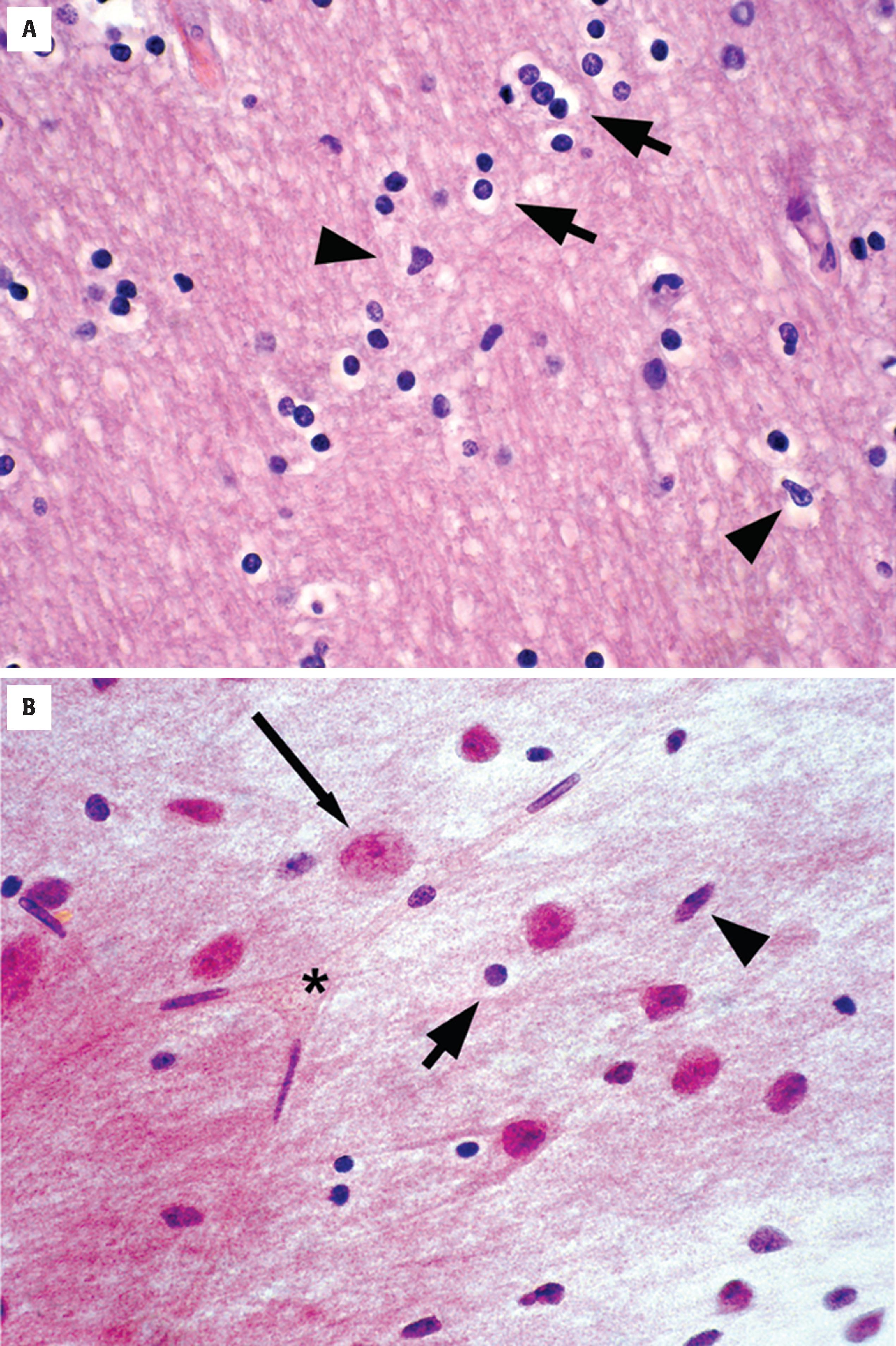 FIGure 1.10, Normal glia. Normal white matter shows oligodendrocytes ( arrow s), which have round dark nuclei often with a slight perinuclear halo, and astrocytes, with oblong, irregularly shaped nuclei ( arrowhead s). A , Glial cytoplasm blends with the neuropil and cannot typically be noted in the resting state. B , Cytologic preparation of normal cortex demonstrates normal oligodendrocytes ( short arrow ), astrocytes ( arrowhead ), neuron ( long arrow ), and capillary ( asterisk ).