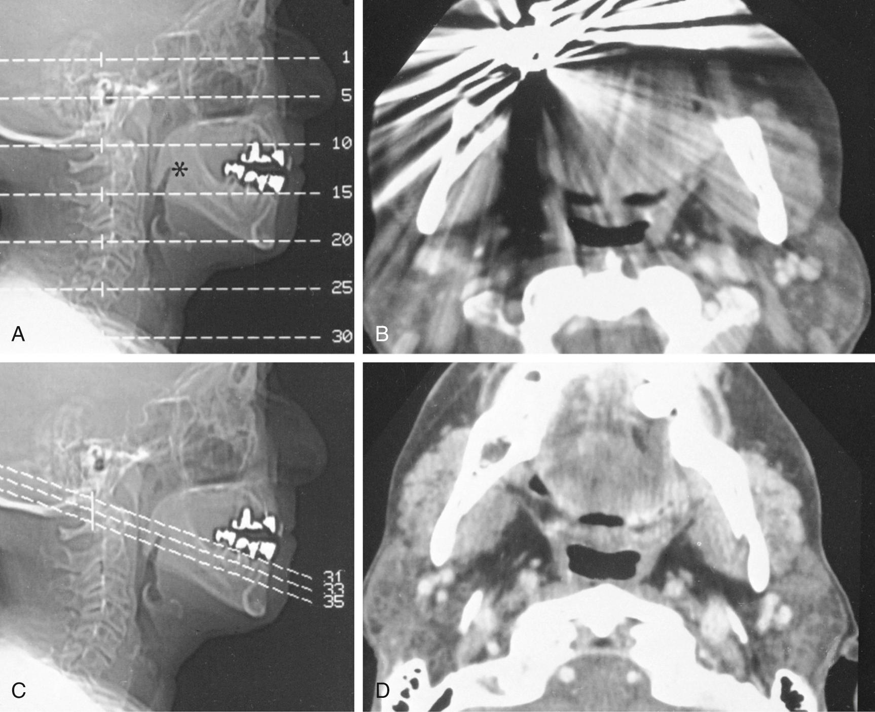 Fig. 8.11, Avoiding dental artifacts on computed tomography (CT).