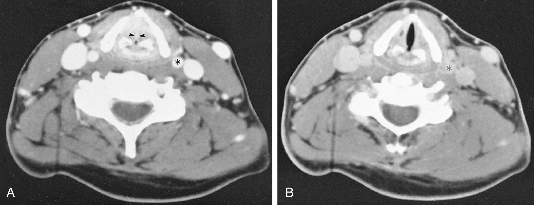 Fig. 8.3, Axial contrast-enhanced computed tomography during breath holding and while phonating.