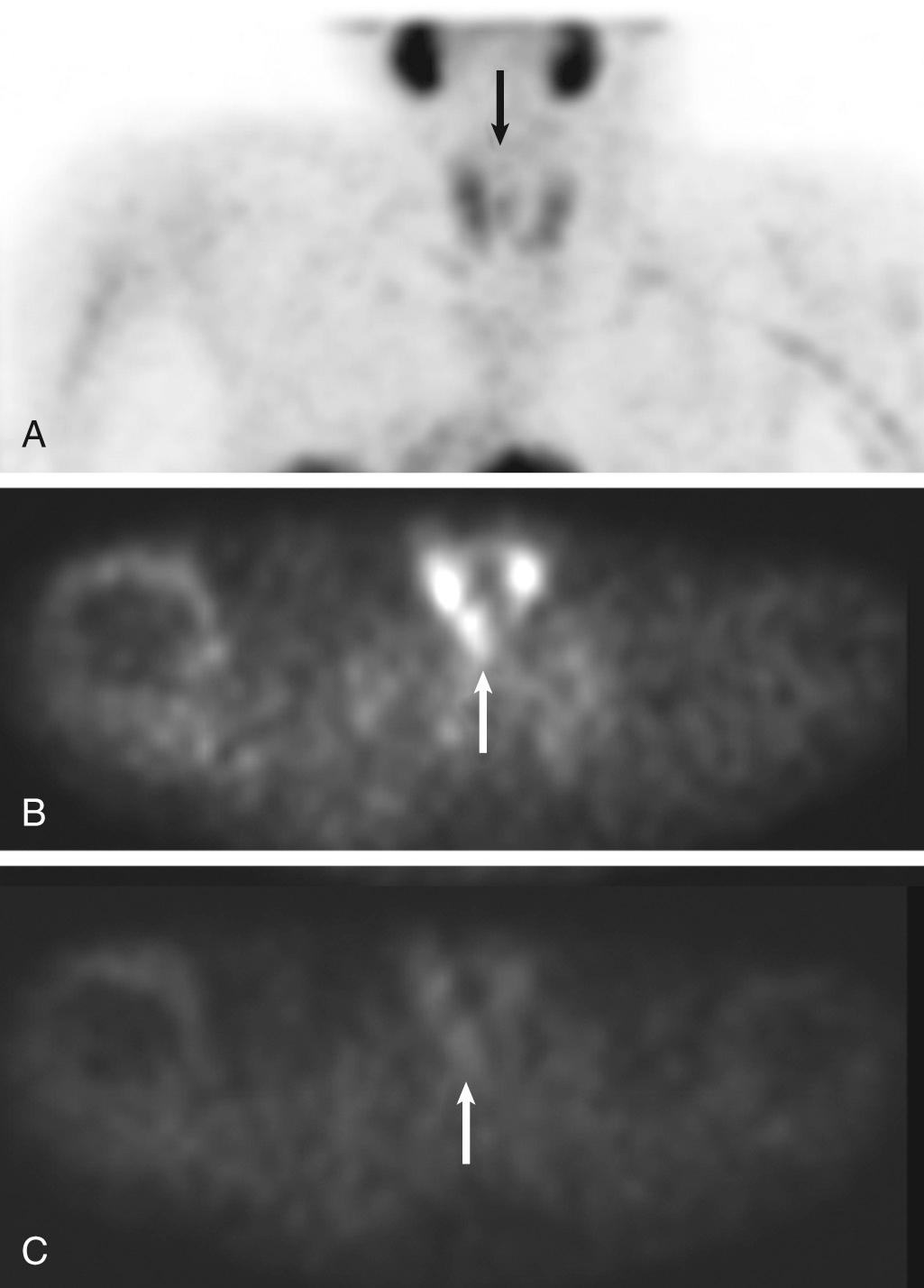Fig. 8.9, (A) Planar early image from a technetinum-99m sestamibi scintigraphy in a patient with suspected parathyroid adenoma shows a small region of uptake between the thyroid lobes (arrow) . Note physiologic uptake in the submandibular and thyroid glands. (B) Early single-photon emission computed tomography (SPECT) image localizes the uptake posterior to the thyroid glands in the paraesophageal region. (C) Delayed SPECT images show the expected washout of radioactivity from the thyroid glands, whereas the paraesophageal lesion retains radionuclide, consistent with parathyroid adenoma.