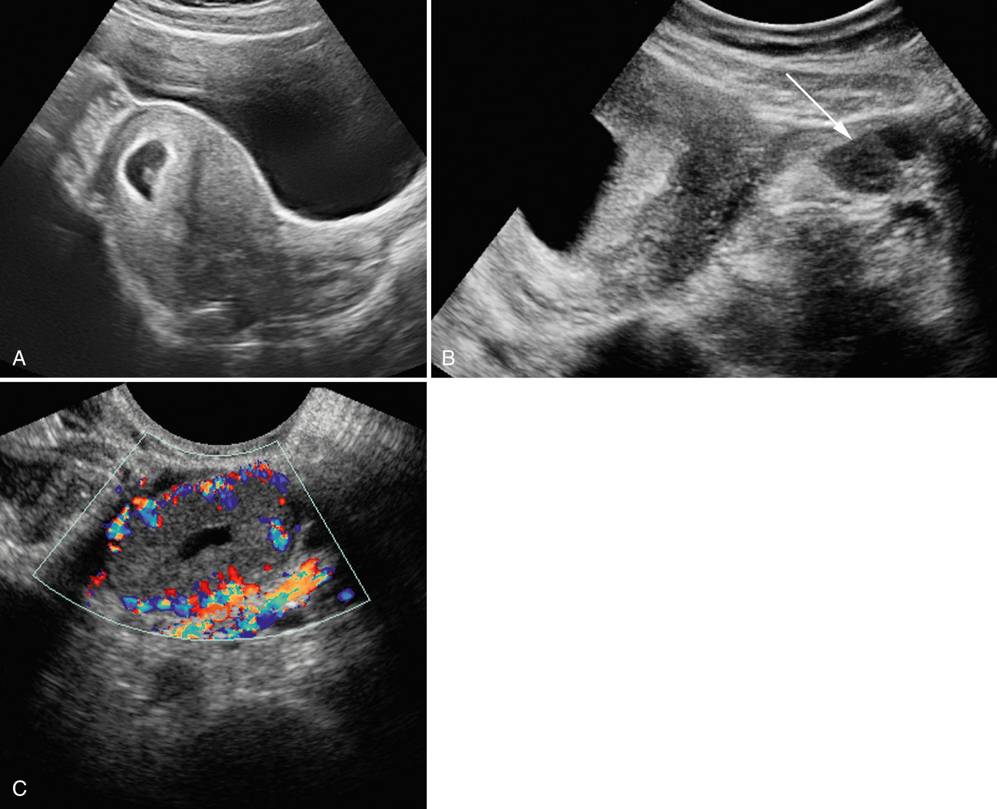 FIG. 28.1, Normal First-Trimester Ultrasound Images: Pregnancy Location and Adnexa.