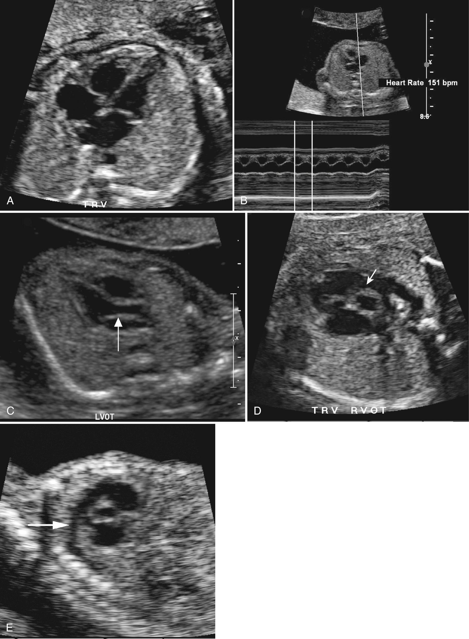 FIG. 28.11, Views of Fetal Heart and Outflow Tracts.