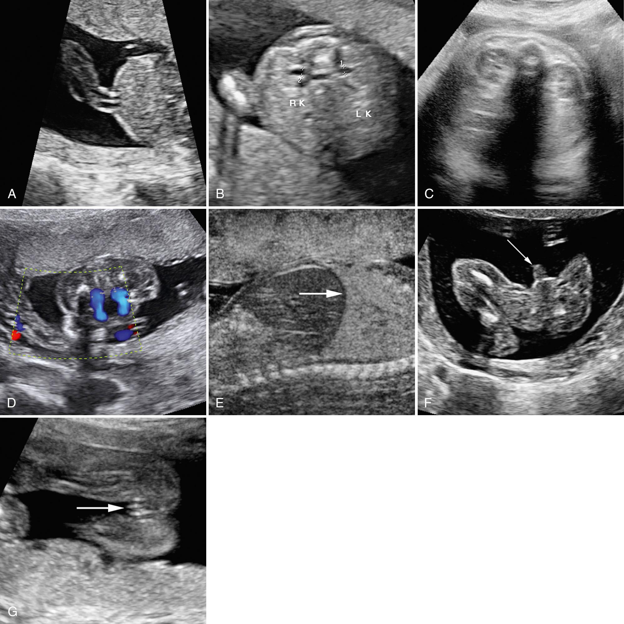 FIG. 28.12, Views of Fetal Abdomen and Pelvis.