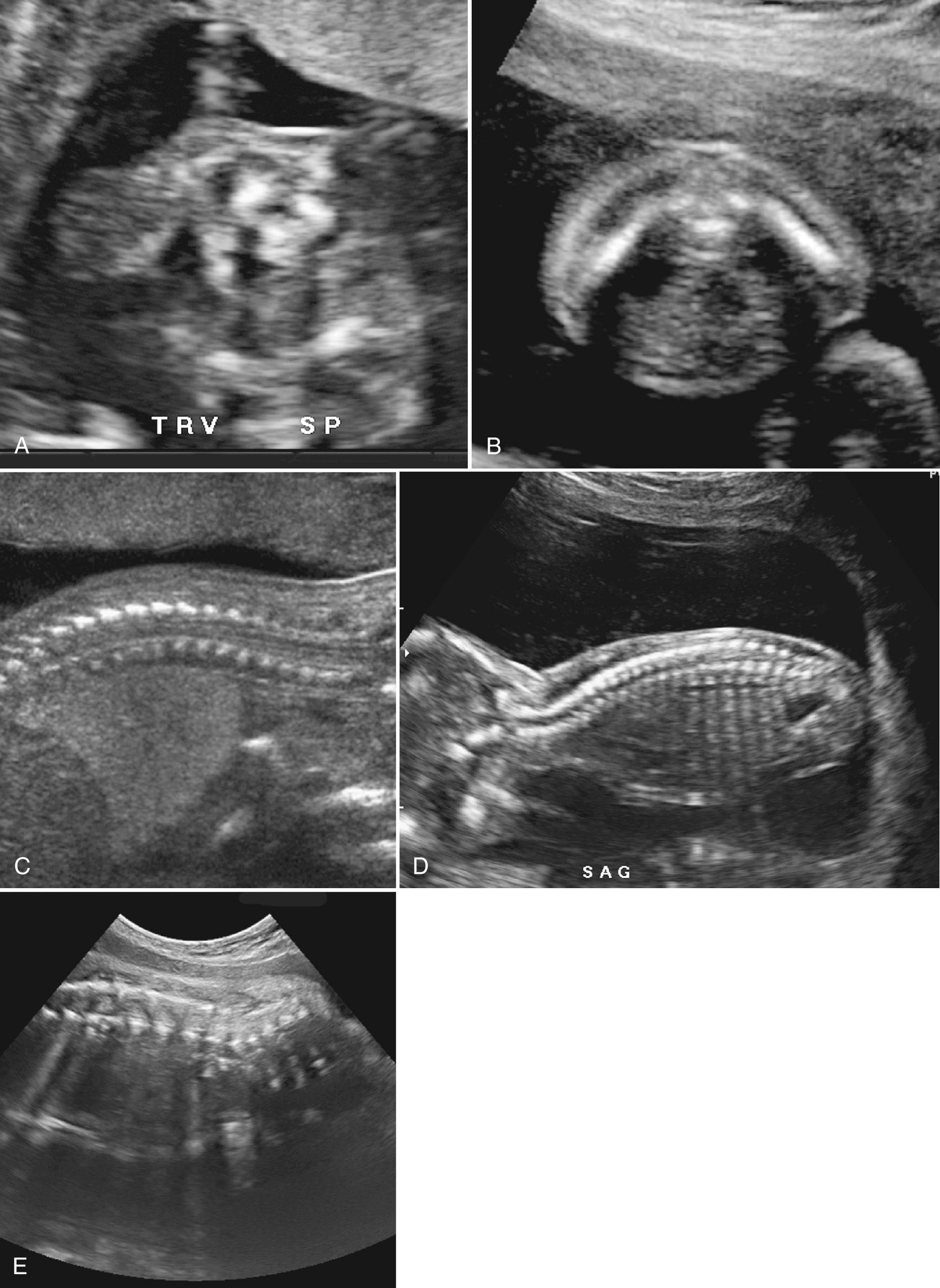 FIG. 28.13, Views of Fetal Spine.