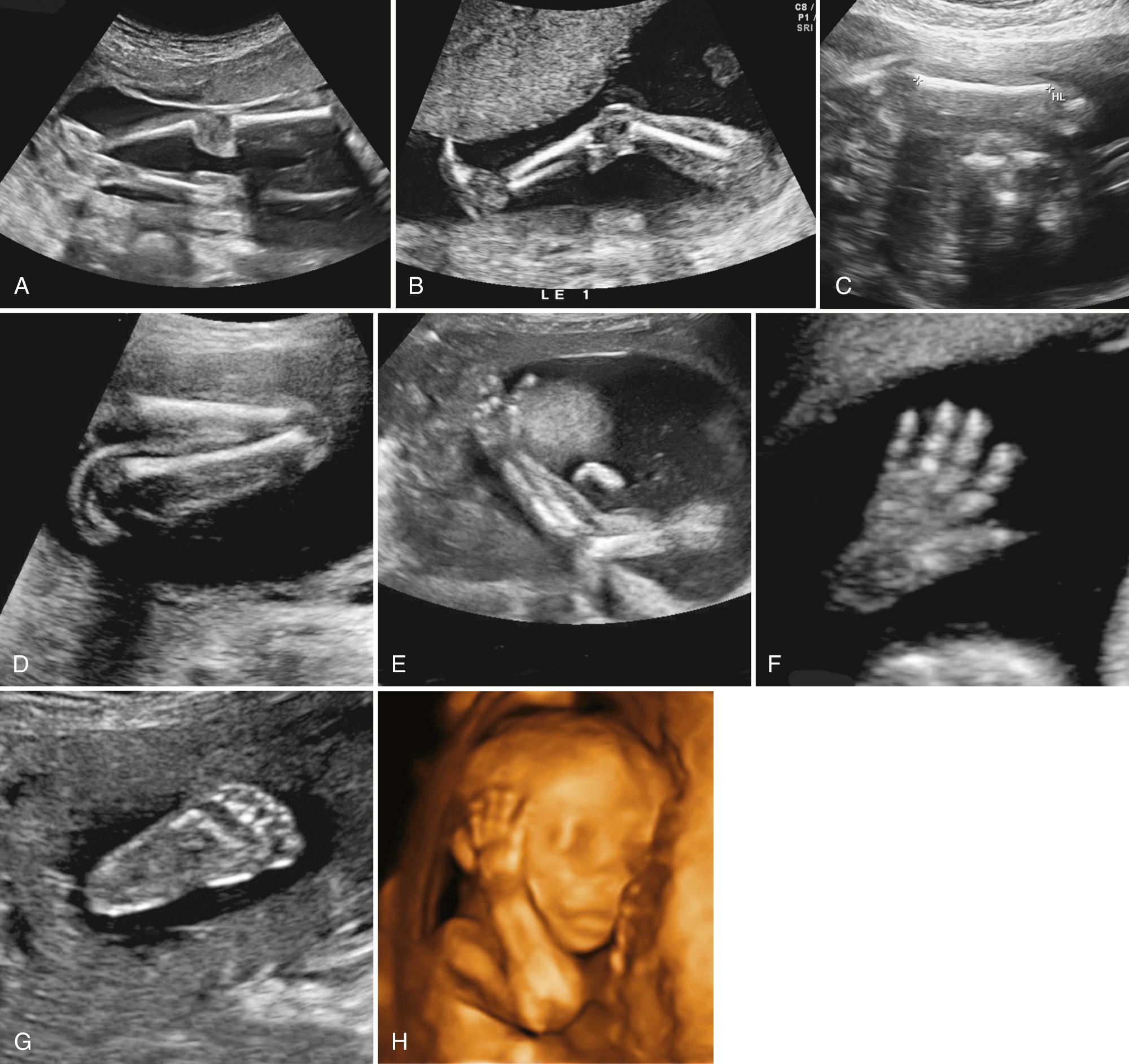 FIG. 28.14, View of Fetal Extremities.