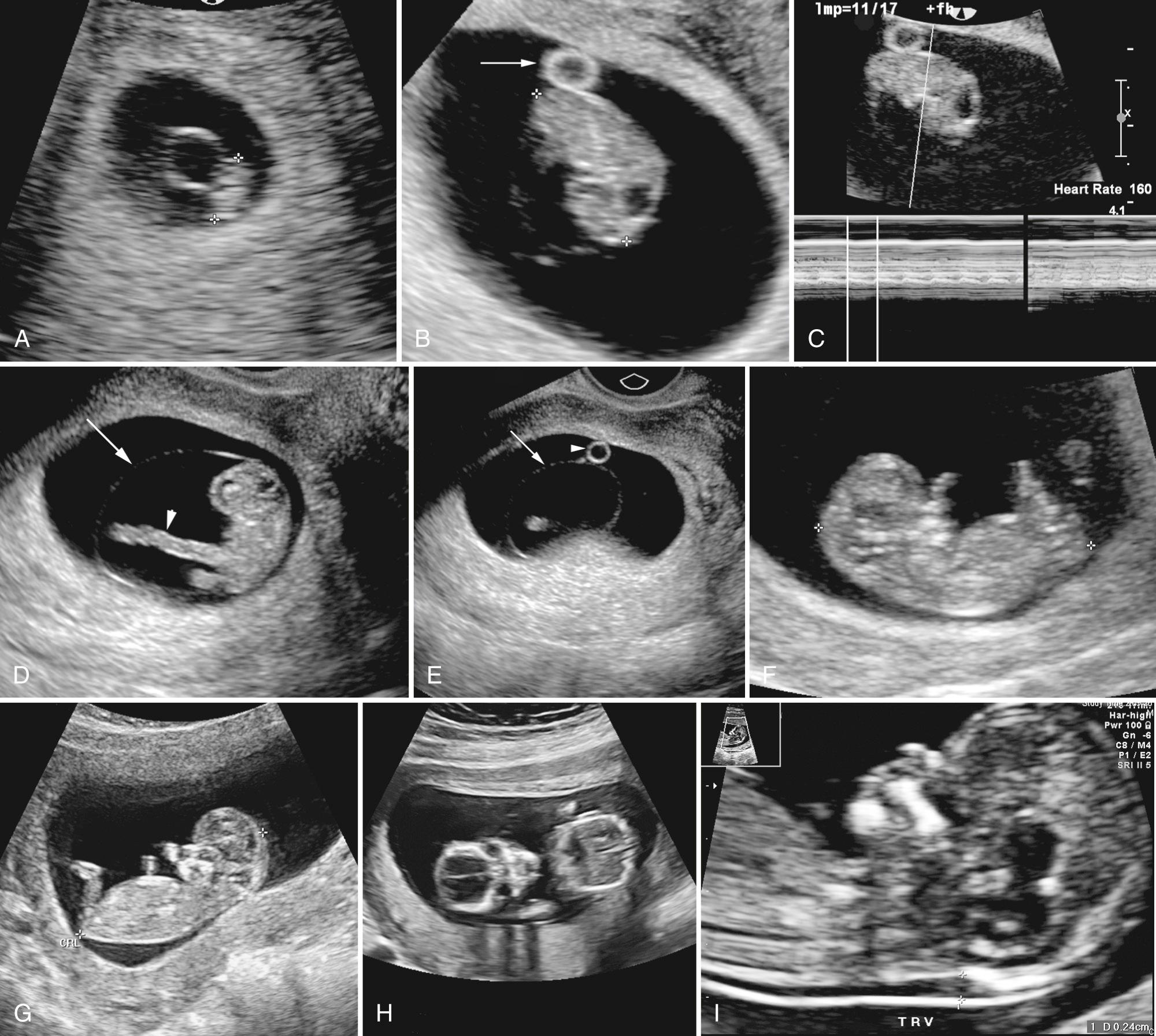 FIG. 28.3, First-Trimester Ultrasound Images: Embryo and Fetus.