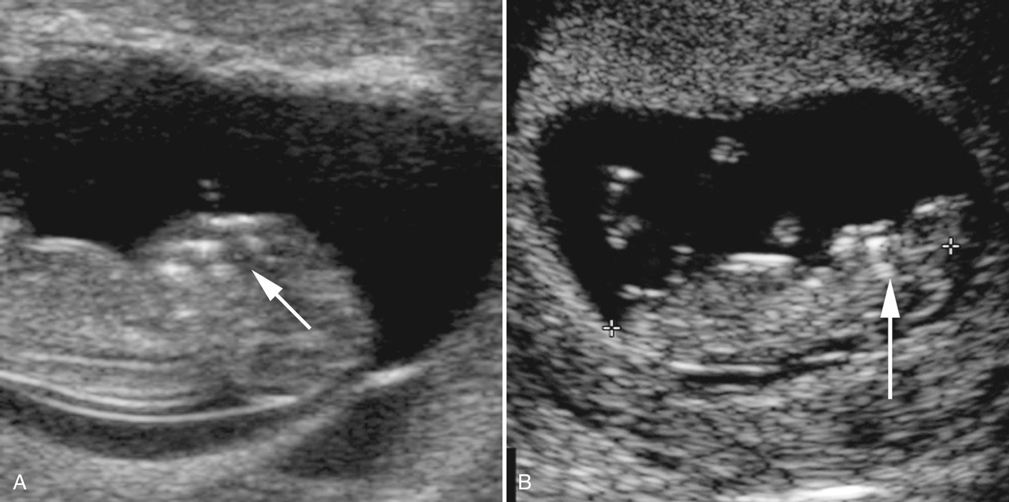 FIG. 28.5, Anencephaly.