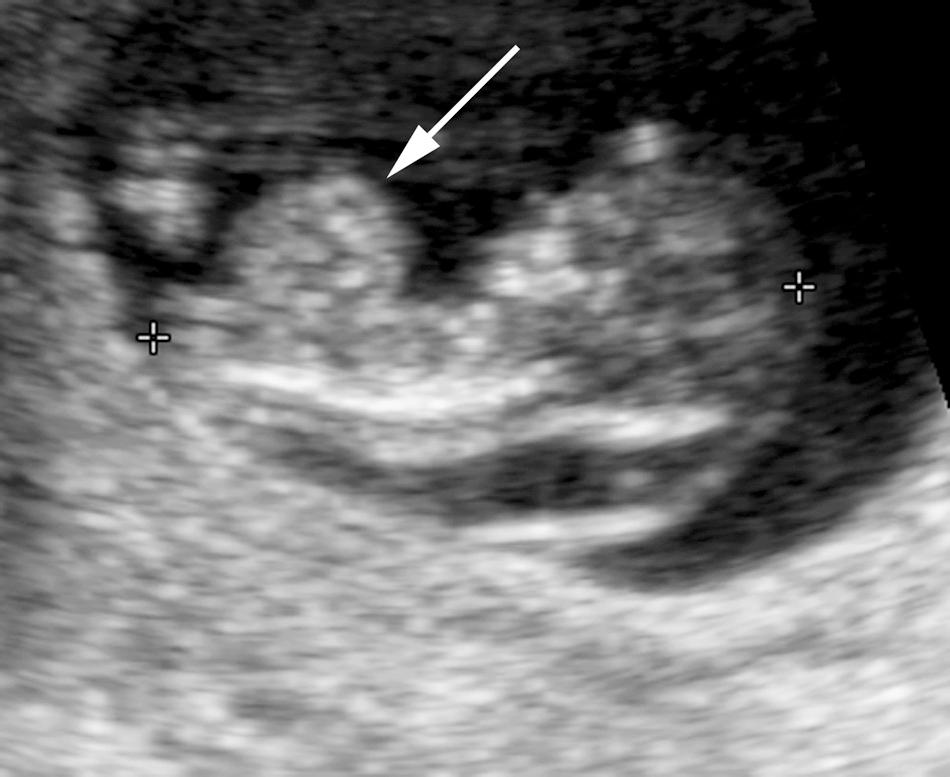 FIG. 28.6, Omphalocele at 11 Weeks' Gestational Age.