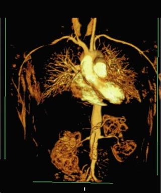 Fig. 39.1, Large-vessel vasculitis with stenotic lesions of abdominal aorta and left subclavian, left carotid, and bilateral renal arteries as imaged using three-dimensional dynamic gadolinium-enhanced magnetic resonance angiography.