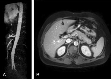 Fig. 39.2, Polyarteritis nodosa with stenotic lesions (A) and wall thickening and enhancement (B) of celiac and superior mesenteric arteries imaged using three-dimensional dynamic gadolinium-enhanced magnetic resonance angiography.