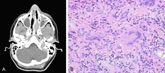 Fig. 39.3, Severe Sinusitis in a Patient With Granulomatosis With Polyangiitis.