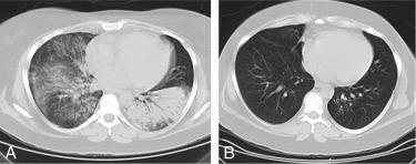 Fig. 39.4, Pulmonary Hemorrhage in a Patient With Granulomatosis With Polyangiitis as Seen on Chest Computed Tomography Scans.